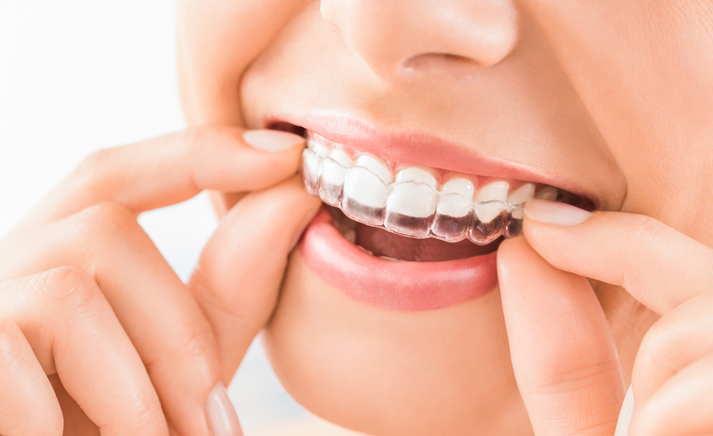 What to Expect During Your First Week of Invisalign Treatment